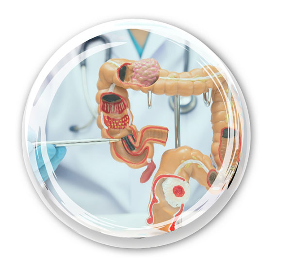 colorectal cancer can be prevented