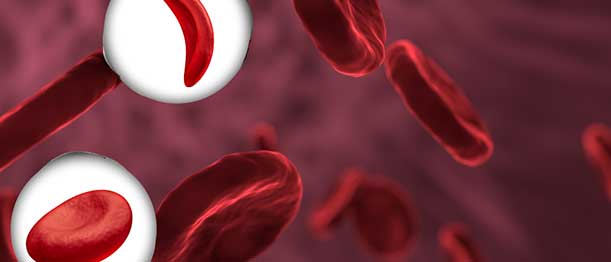 Understanding Sickle Cell & Anemia